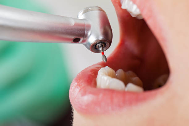 Best Emergency Root Canal Therapy in Conroe, TX